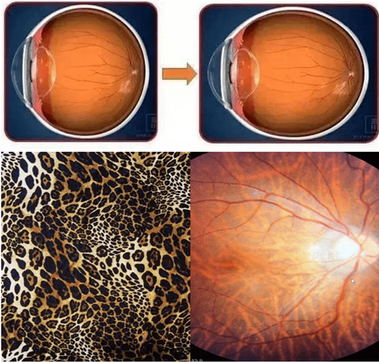 豹纹状眼底演变