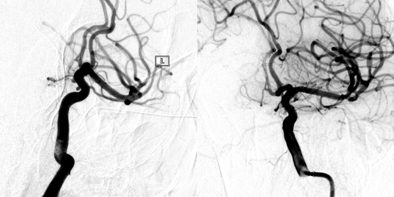 漯河市中心医院多学科协作 微创介入巧拆颅内“不定时炸弹”