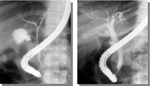 九旬老人突发“全身蜡黄”，内镜巧手40分钟解除胆道危机
