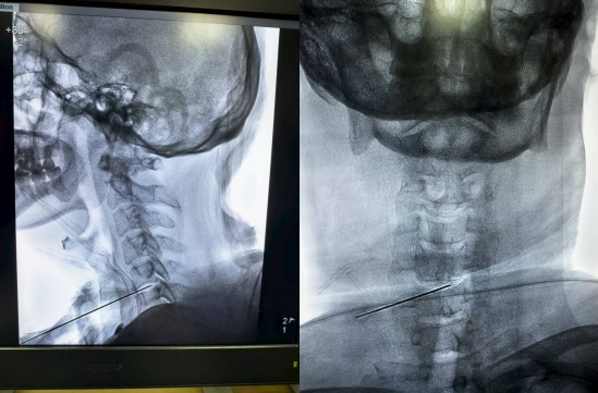 脖子疼、手发麻？别硬扛！这种微创技术帮您摆脱颈椎间盘突出困扰