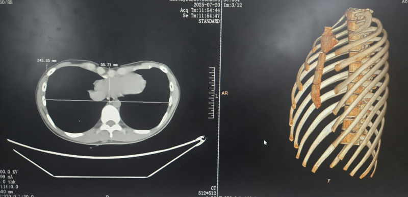 漯医力量“托”起凹陷胸膛！Nuss微创术，为重度漏斗胸少年点亮自信之光