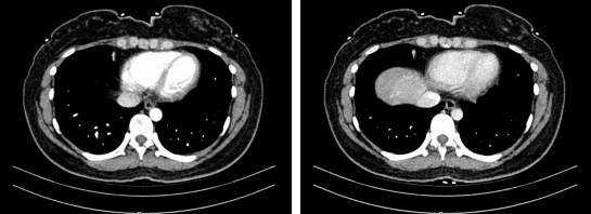 肝内“雷区”毫厘间排险！漯医肝胆外科成功挑战肝内深部高危肿瘤