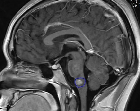 精准识别，协同诊疗——漯河市中心医院神经内科成功救治一例MOGAD患者
