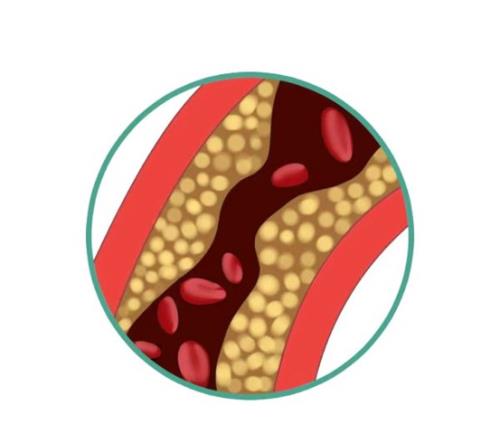 「科普」合理控制低密度脂蛋白有助于降低冠心病风险
