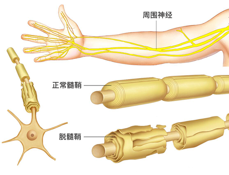 「科普」格林巴利综合征，突发肢体无力需警惕